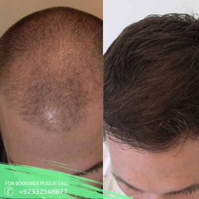 hair transplant in Islamabad