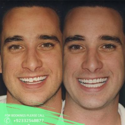 Teeth scaling cost in Islamabad