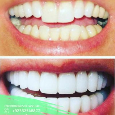 Teeth scaling treatment in Islamabad