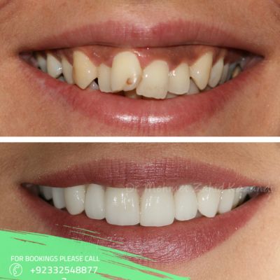 Teeth scaling before after result