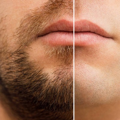 beard hair transplant