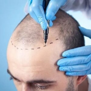 4000 & 5000 Grafts Hair Transplant Cost in Islamabad