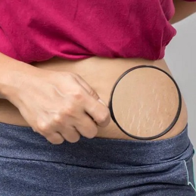 Can Laser Treatment Get Rid of Stretch Marks?