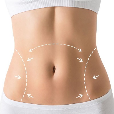 Preventing And Managing Swelling After Tummy Tuck Surgery in Pakistan