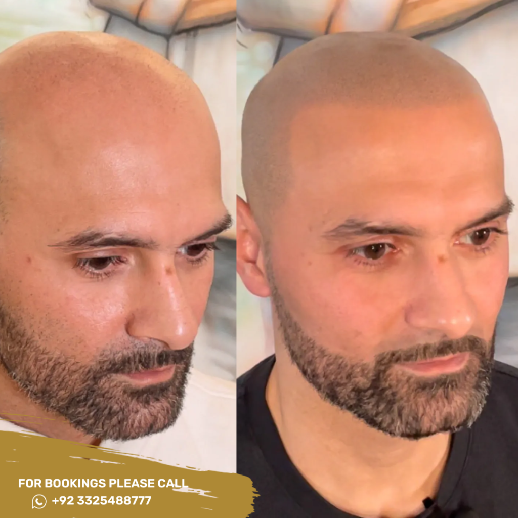Fue hair transplant cost in Islamabad