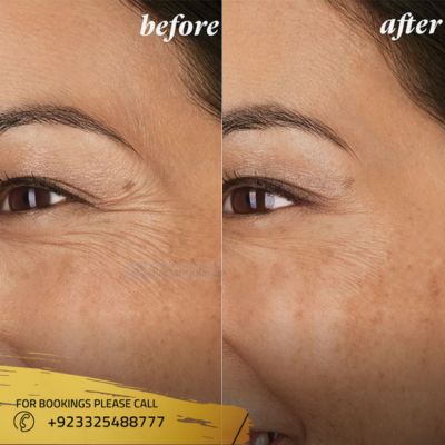 Before after of botox injections in Islamabad