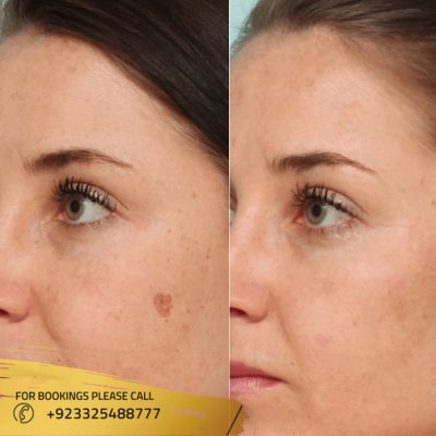 Before after of skin tag removal in Islamabad