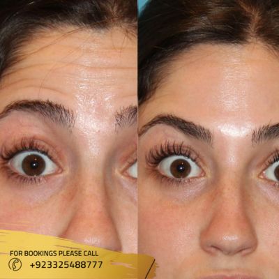 Images of botox injection in Islamabad