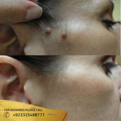 Images of skin tag removal in Islamabad