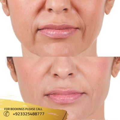 Result of botox injections in Islamabad