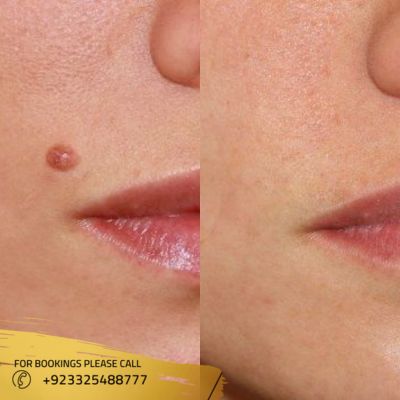Result of skin tag removal in Islamabad