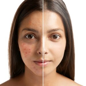 What Happens During an Acne Scar Consultation with A Dermatologist