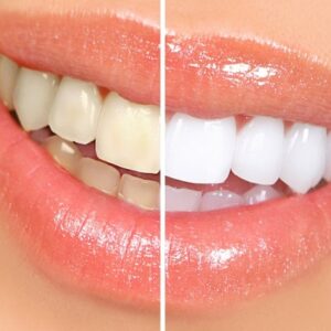 What’s the best way to whiten your teeth?
