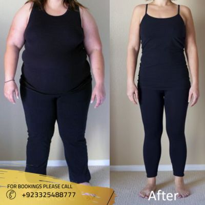 Before After of Bariatric surgery in Islamabad
