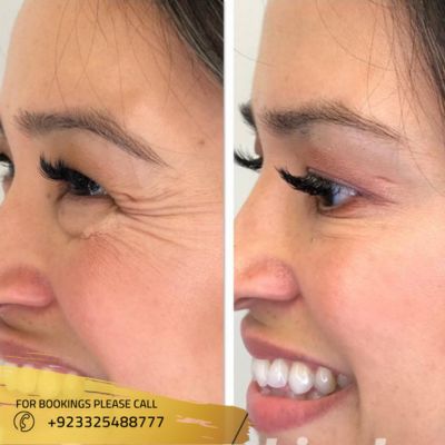 Before after of Botox for wrinkles in Islamabad