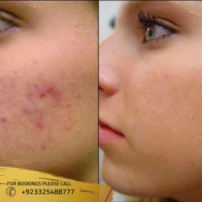 Before after of Laser acne treatment in islamabad