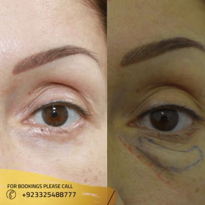 Before after of eyebag removal in islamabad
