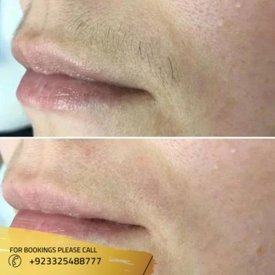 Before after of laser hair removal in Islamabad