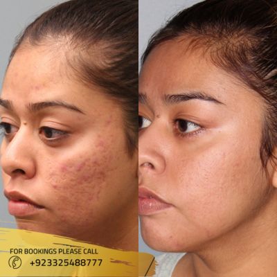 Before after of laser skin resurfacing in Islamabad