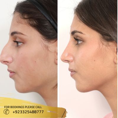 Images Of Double chin removal in islamabad (2)