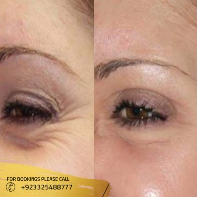 Images of Botox for wrinkles in Islamabad