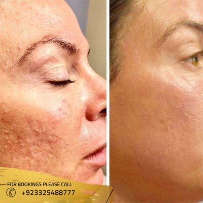 Images of Laser acne treatment in islamabad