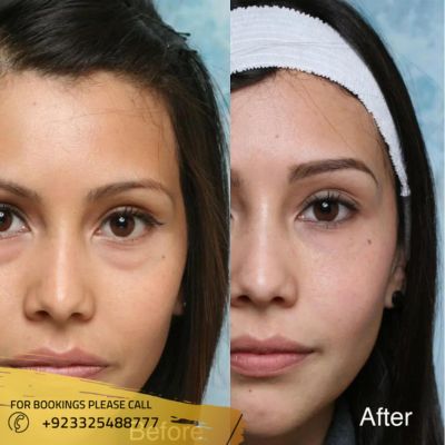 Images of eyebag removal in Islamabad