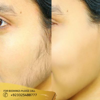 Images of laser hair removal in Islamabad