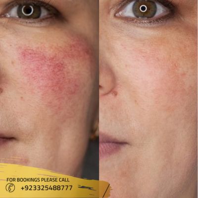Images of laser skin resurfacing in Islamabad