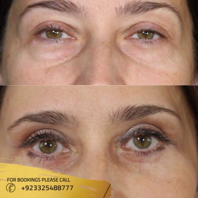 Result of eyebag removal in Islamabad