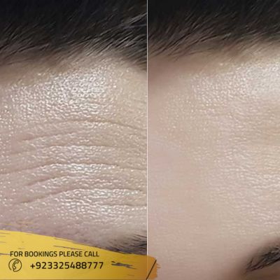 Results of Botox for wrinkles in Islamabad