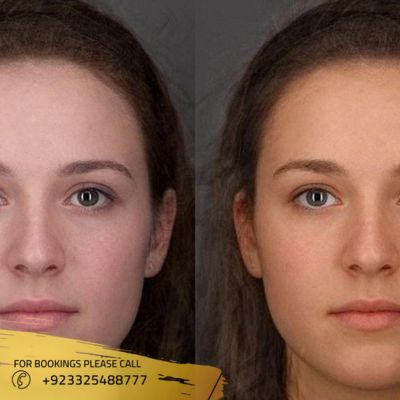 Results of Glutathione skin whitening injections in Islamabad