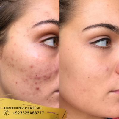 Results of Laser acne treatment in islamabad