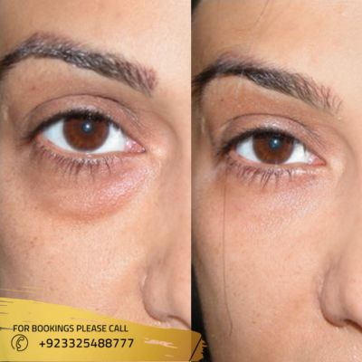 Results of eyelid surgery in Islamabad