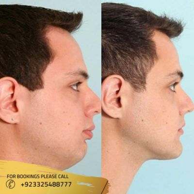 Results of jaw surgery in islamabad