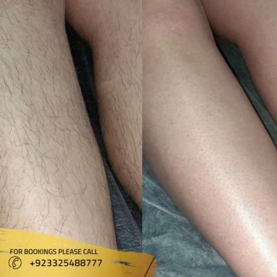 Results of laser hair removal in Islamabad