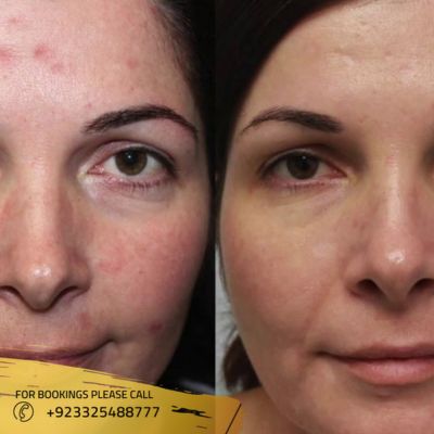 Results of laser skin resurfacing in Islamabad
