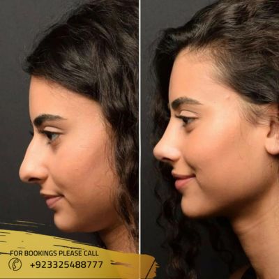 before after of jaw surgery in islamabad
