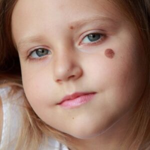Can Birthmarks Be Surgically Removed?