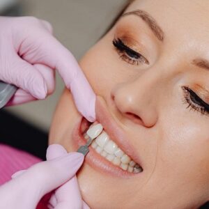 Which Dental Veneers in Islamabad Are the Best?