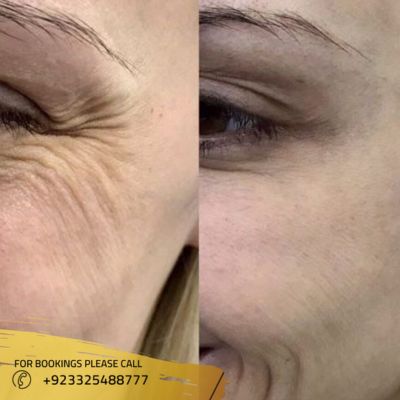 Images of hifu treatment in Islamabad