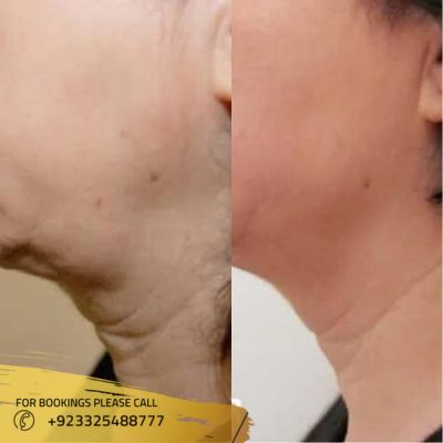 Results of hifu treatment in Islamabad