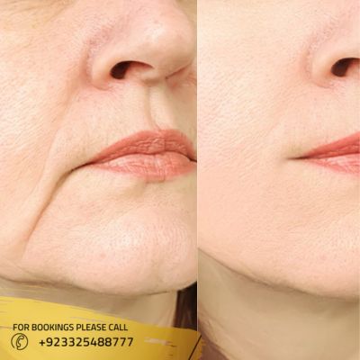 before after of hifu treatment in Islamabad