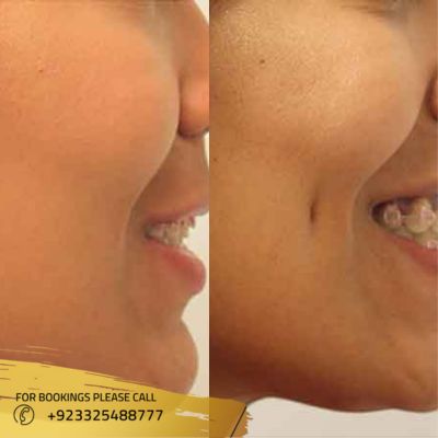 images of dimple creation in Islamabad