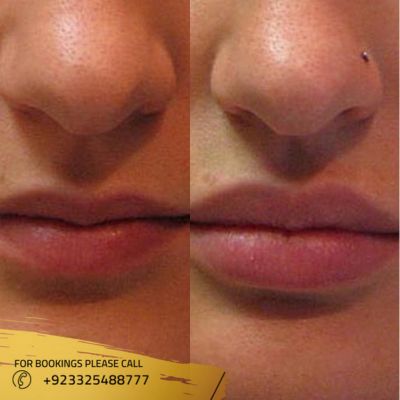 images of lip augmentation in Islamabad