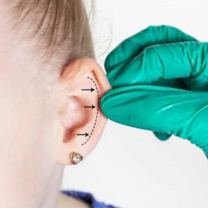 Do otoplasty scars go away?