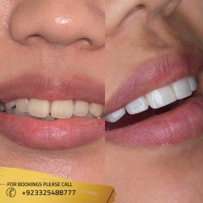 Images of dental crown in Islamabad