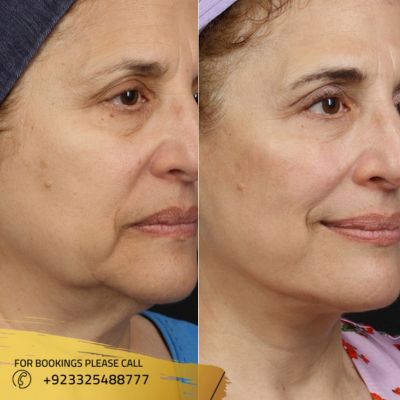 Images of facelift treatment in Islamabad (1)