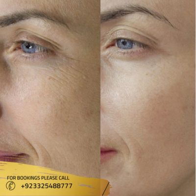 images of microneedling treatment in Islamabad