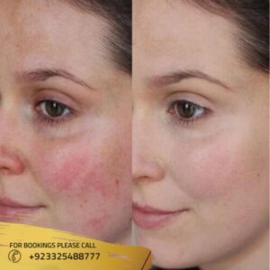 Pakistan Rash 62 Rashes Treatment in Islamabad-Rawalpindi & Pakistan